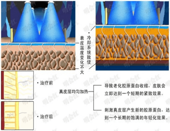 玛吉|各种网红测评的热玛吉效果真实吗？闺蜜决定要去做了