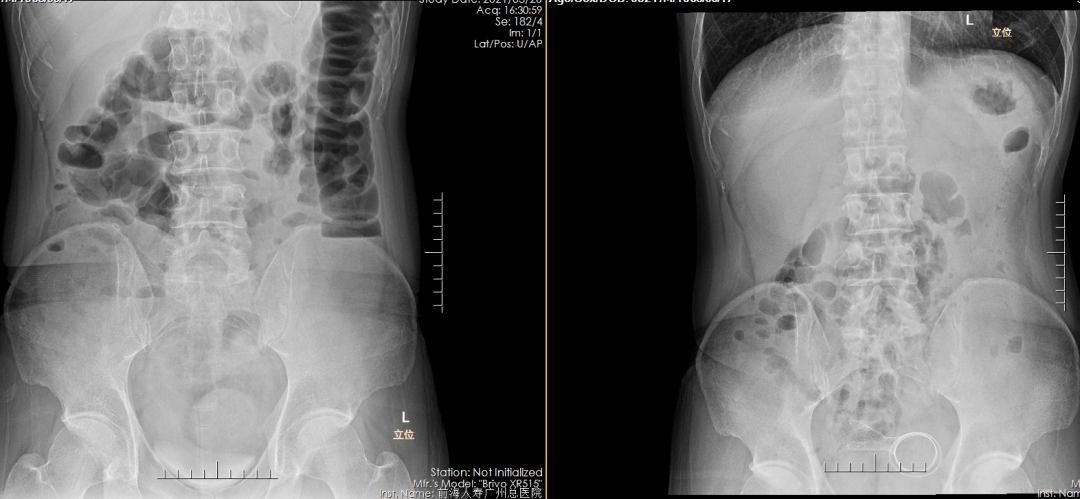 结肠癌x线图片图片