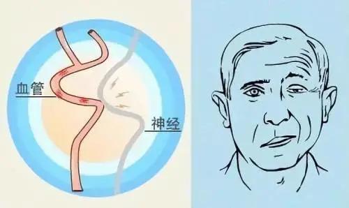 功能|面肌痉挛就是面瘫？两种疾病傻傻分不清 专家：病因不同，别乱治！