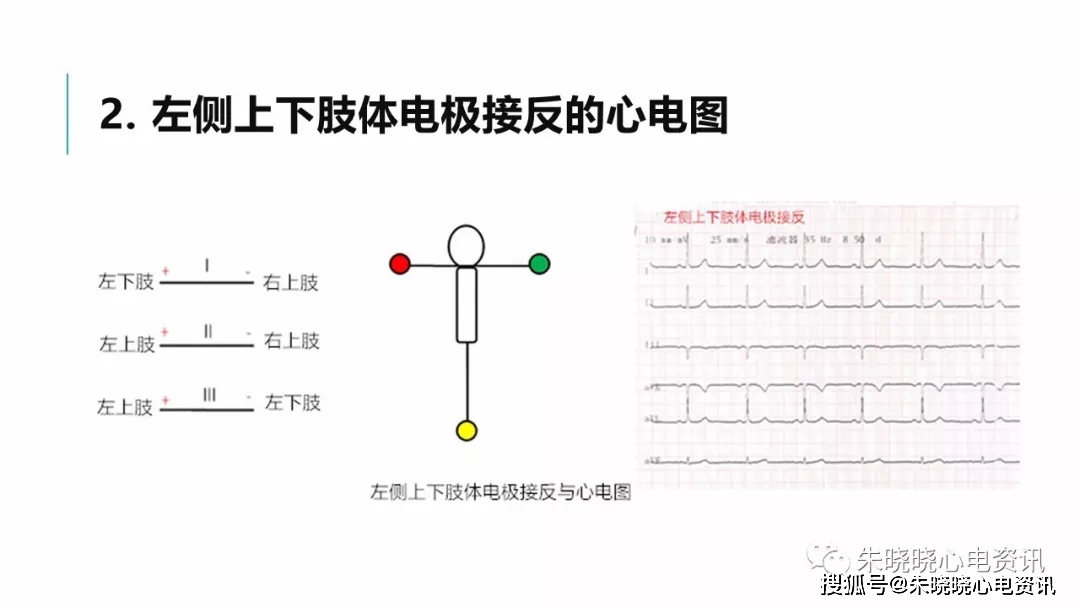 肢體導聯電極錯接心電圖分析及鑑別ppt