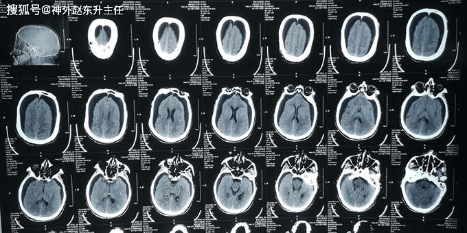 當時查頭部ct提示雙側硬膜下積液,也稱為外部性腦積水