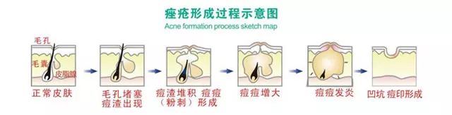 长痘痘|长痘期间，你应该怎样护肤，才能更快祛痘？详细护肤方法都在这！