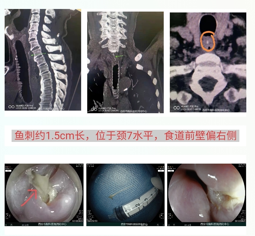 张蓉|骨鲠在喉？别再用“土方法”了！消化内镜最有用