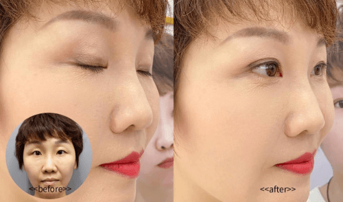 传统|美贝尔原生隐痕魅眼术打破传统技术壁垒实现革命性突破