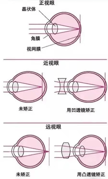 视力|孩子远视度数大，就只是眼睛看得远点？远视也是病？