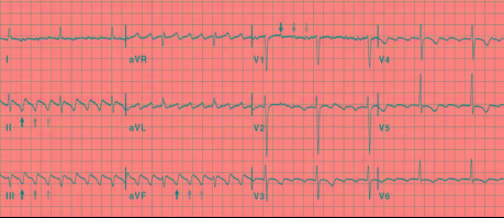 频率|【一“心”只为您“健”康】心房扑动患者，要尽早治疗！