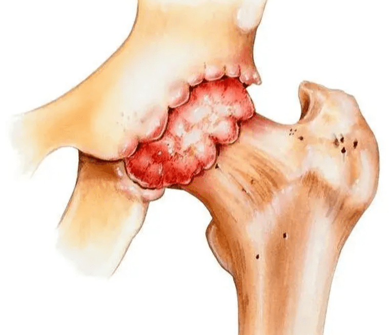 骨质增生就是骨刺引起的?描瑶古方:骨质增生不仅仅只是骨刺