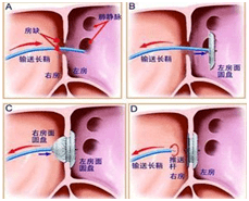 採用經食道超聲引導下微創卵圓孔未閉封堵術進行此類疾病的手術治療