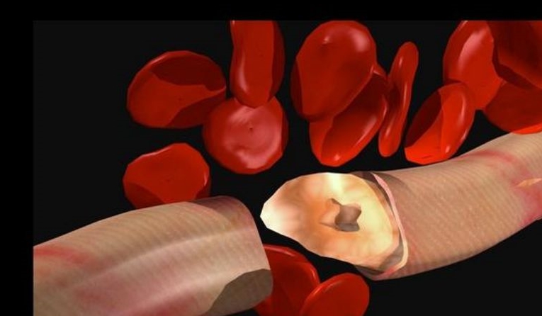 治疗|高血压患者请不要做这三件事，会伤害肾脏，必须早预防！