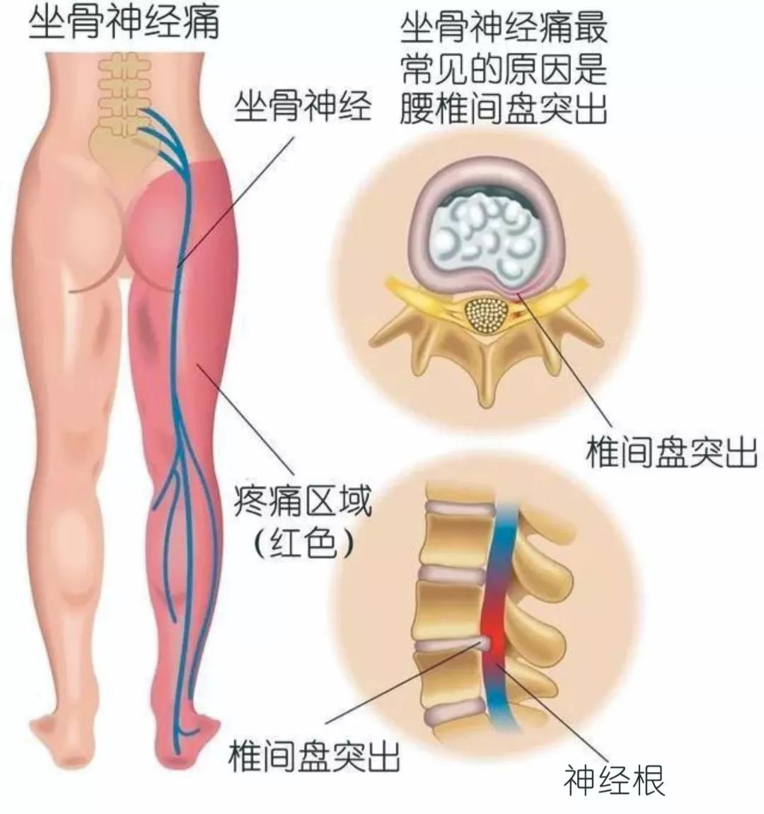 诊断|腰椎间盘突出=腰椎间盘突出症？NO！两个有着天壤之别!