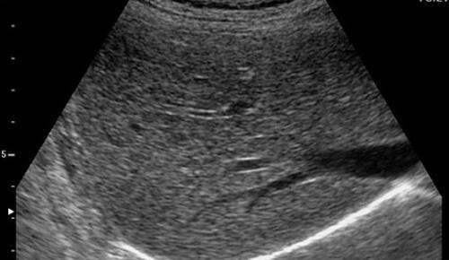 病毒|如果你体检发现两对半异常，知道有乙肝但不知该怎么办，请看此文