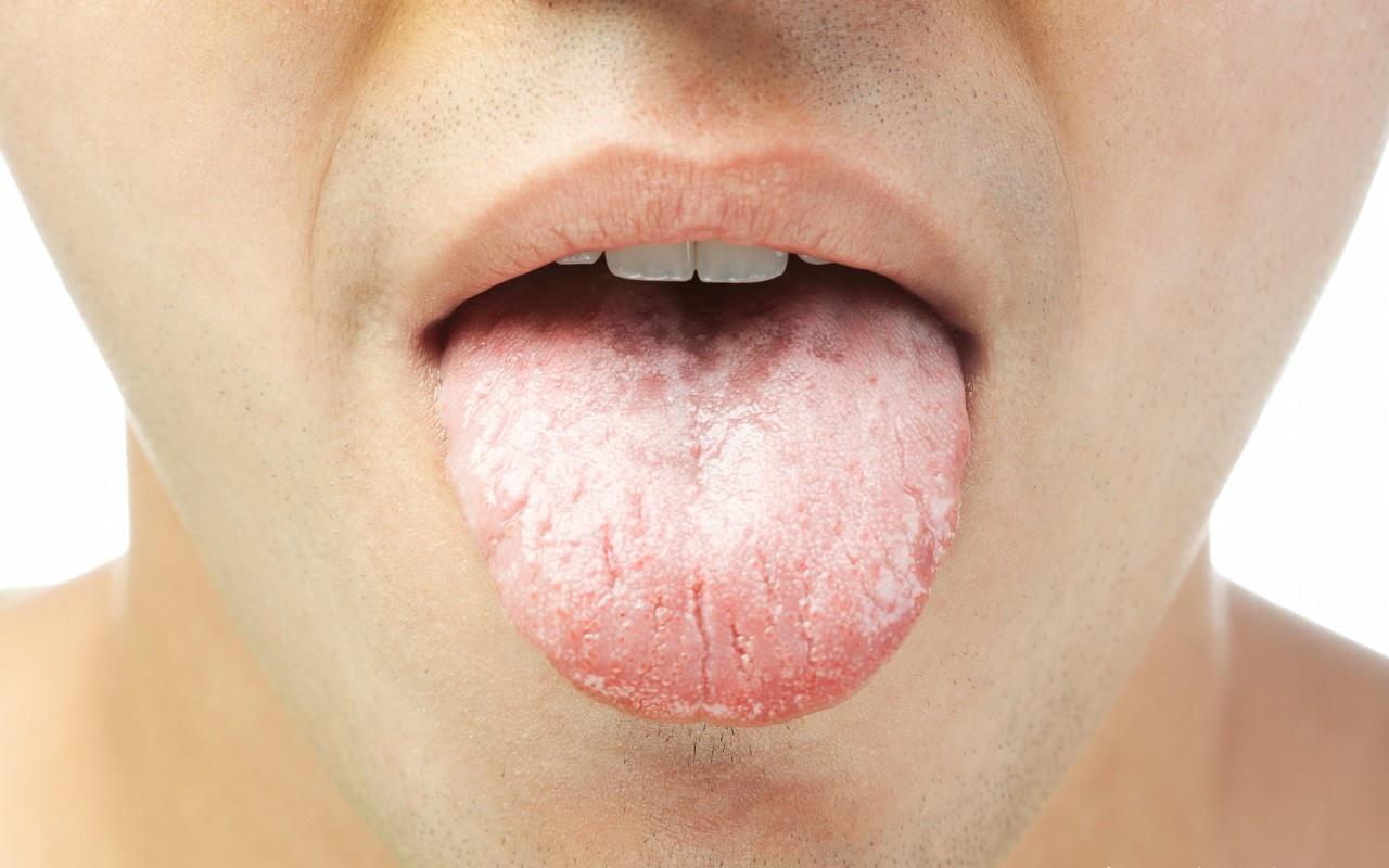 治疗舌苔白腻的中成药（舌苔厚白最快消除方法）