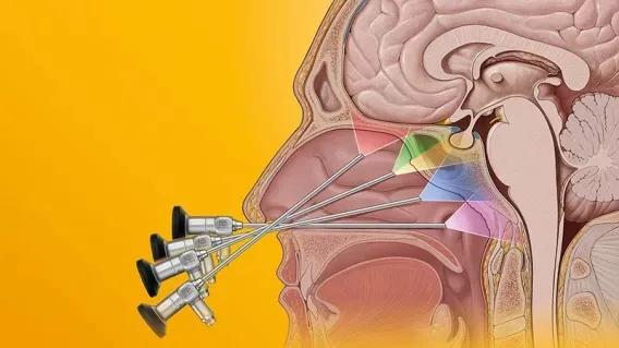 手术|10岁小女孩身材比同龄人矮小,做核磁竟查出“颅咽管瘤”!