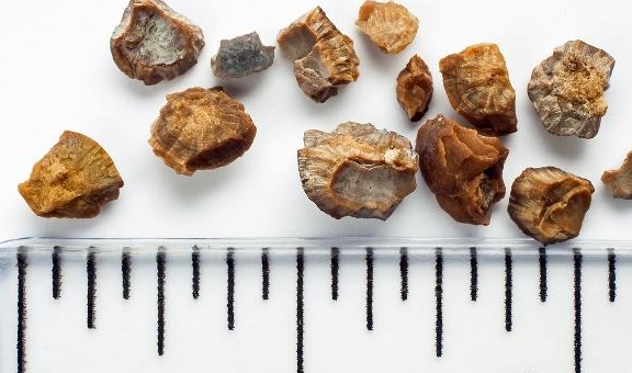 诊断|生活习惯都很规律，为什么会得肾结石。肾结石是身体内有石头吗？