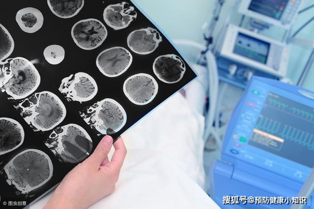 男子|61岁男子突发脑梗，医生：脑梗的真凶找到了，务必远离这一生活习惯