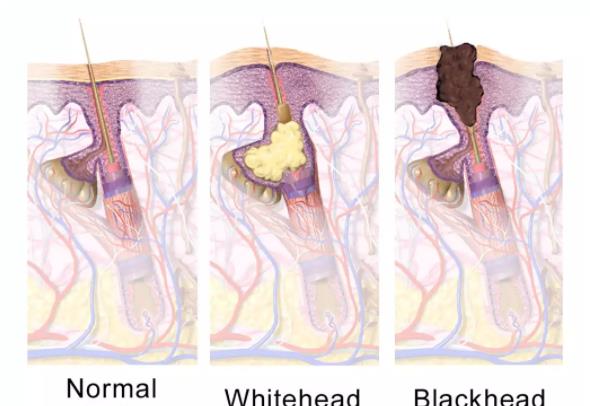 黑头|脸上清洁干净了，为何还是会有黑头？看完这些话，你就恍然明白了