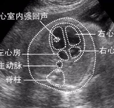 染色体|查出胎儿心室强光点好怕怕