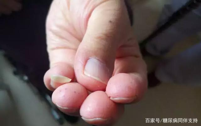 方法|糖尿病照此方法测血糖，不疼还测得准