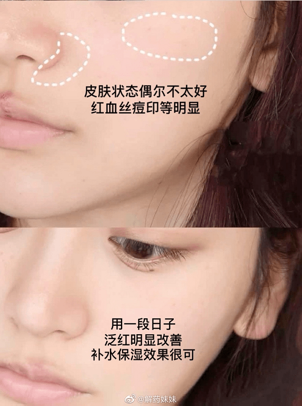 急救|晒伤秒褪红，这个夏天晒后修护神器我只认它
