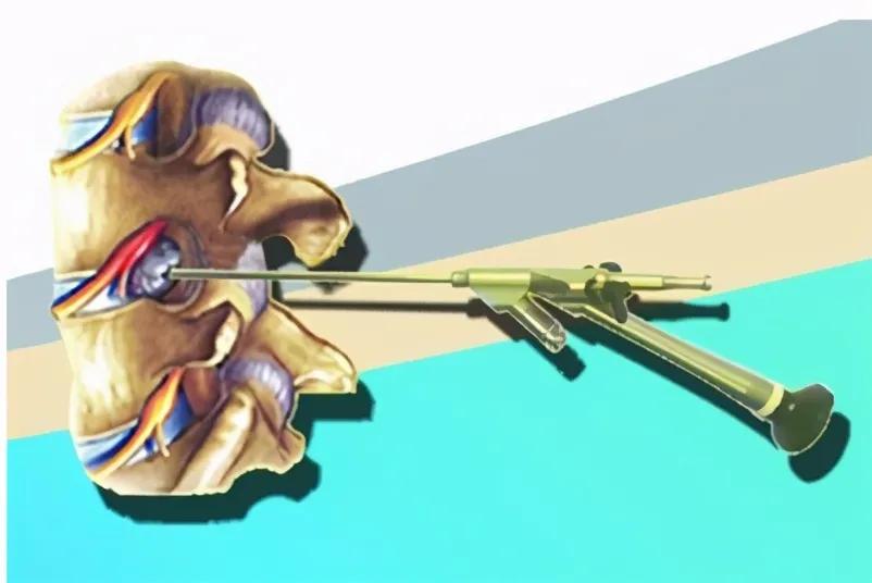 孔镜|76岁大妈经常“走走停停” 专家：当心腰椎管“缩水”