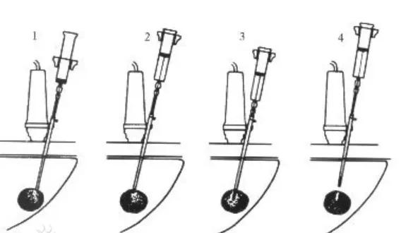医学|超声科医生的手术——介入超声你了解吗？
