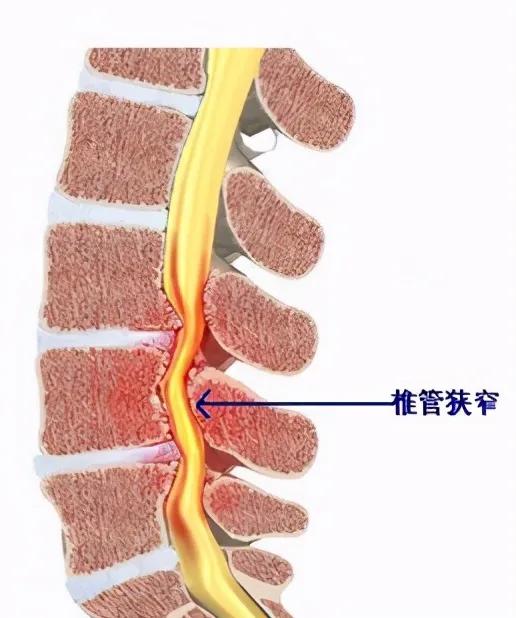孔镜|76岁大妈经常“走走停停” 专家：当心腰椎管“缩水”