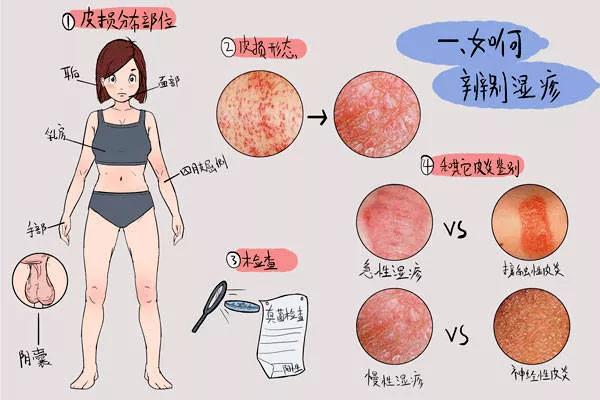 诱发成人长湿疹的原因你知道吗？赶快来了解一下