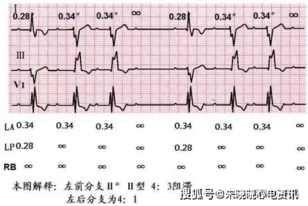束支阻滞心电图解析_传导