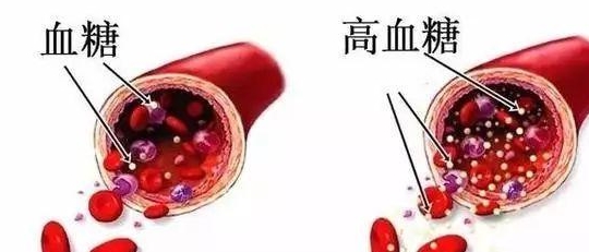 治疗|老糖尿病友血糖控制不佳,卫教师一招解决