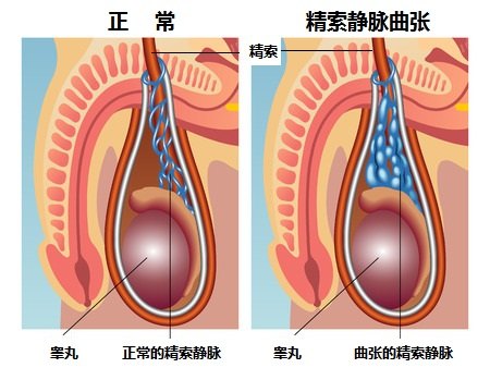 托脉安阴囊托内裤对静脉曲张提睾成效分析