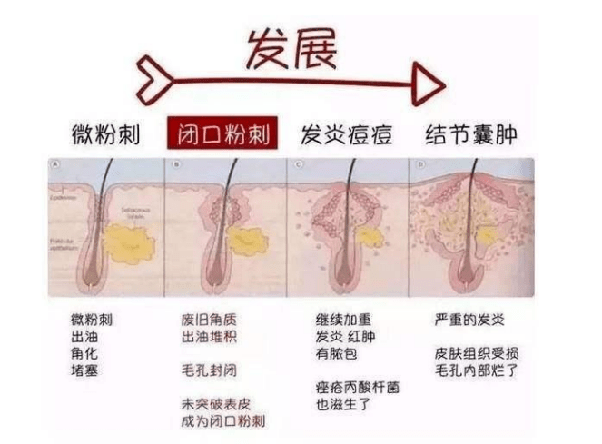 毛孔|佰花方：油痘肌夏日生存指南，让你30s了解并KO它