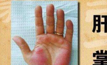 前兆|误以为皮肤过敏，查出肝硬化，提醒：皮肤这一表现或是肝病前兆