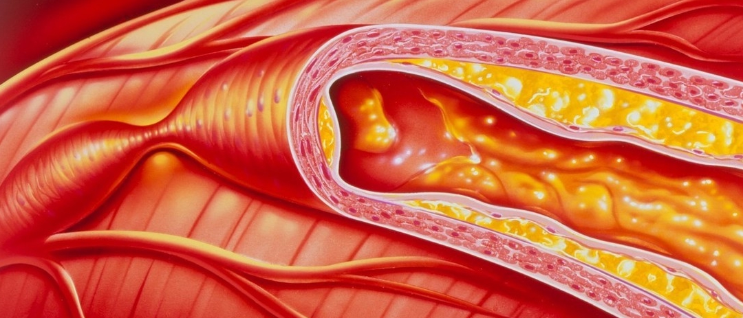 治疗|糖尿病患者如果不戒酒、不忌口、不规律吃药，会有什么后果？