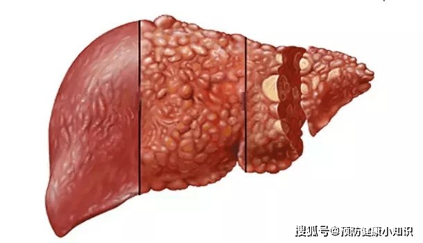 严重|小伙查出肝癌,医生:出现“2痛3臭”,快查查肝