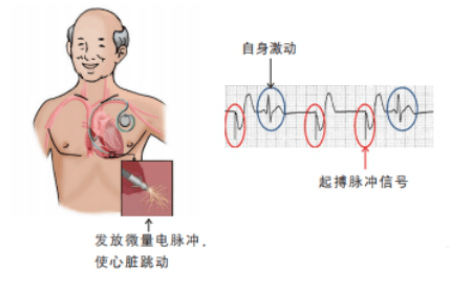 一心只為您健康心動過緩應該安裝心臟起搏器嗎