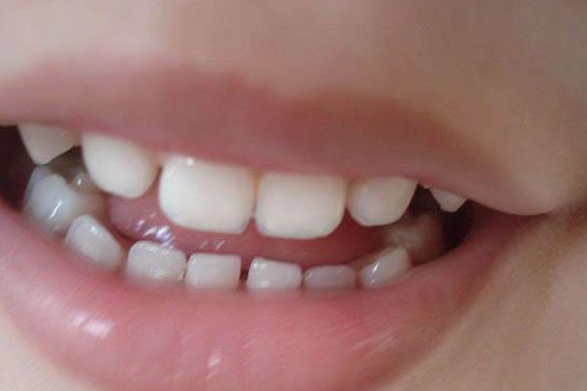 梦见自己掉了半颗牙齿,周公解梦与心理暗示的深层剖析 梦见自己掉了半颗牙齿,周公解梦与心理暗示的深层剖析