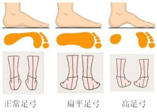如何判断儿童是否有严重扁平足,又需去哪里定制矫正鞋