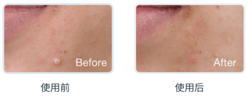 技术|NoNo祛痘净肤仪 24小时急救消炎祛痘