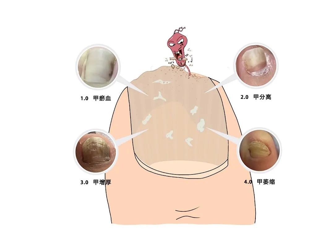 甲真菌癣的5种类型分类鉴别这都有