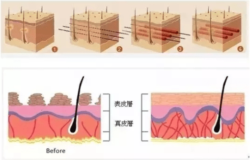 蛋白|怕怕的：线雕后凹凸不平能好码，线雕一个月后脸还是硬，踩坑了！