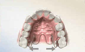 长度|何晓天医生：很多人不了解牙齿矫正中的扩弓是什么？看完这个你就知道了！