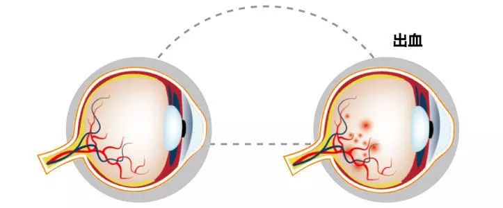 眼底出血该怎么办