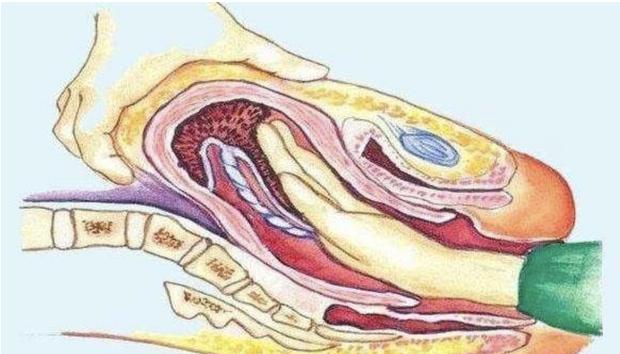 子宫|它比分娩疼“百倍”,3D图像还原太真实,宝妈直呼:半条命没了!