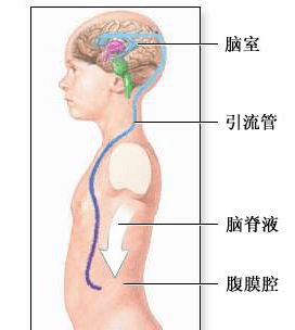 分流管|先天性脑积水患者这一路是怎么走过来的？