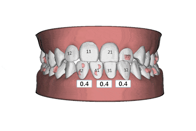 系列|暑期科普系列直播——儿童牙齿矫治那些事儿（第六期、第七期）