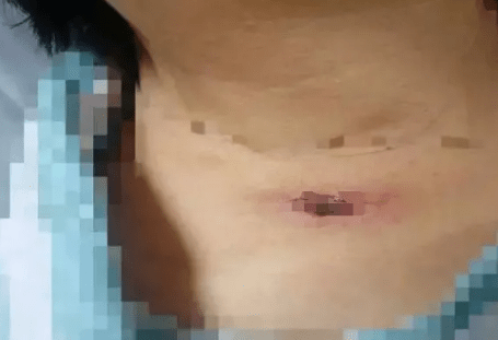 阿姨|可怕！2人高烧不退，核酸阴性！近期千万当心！