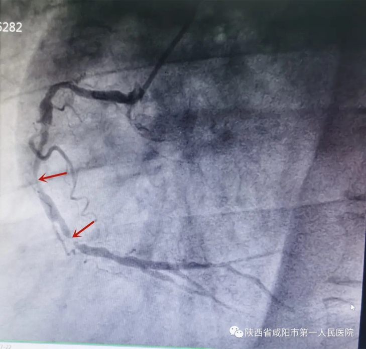 冠脉|咸阳市第一人民医院：多科室密切协同，成功完成一例二尖瓣成形+冠脉搭桥术