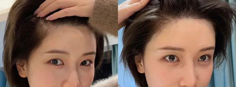 调整|赵露思调整发际线后显瘦10斤?提升颜值,拯救发际线小妙招来了!
