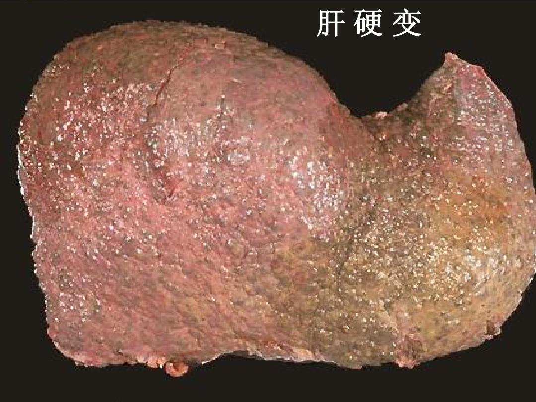 症状|早期肝硬化的“3大类症状”答案都在脸上，注意观察