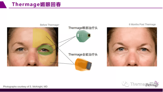 br|眶周老化丨热玛吉眼部专项抗衰第二期